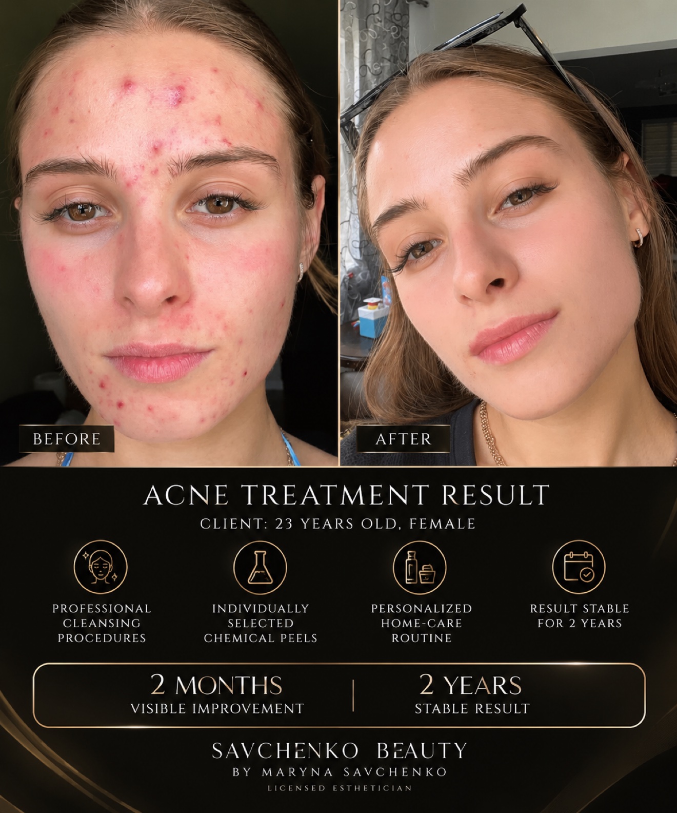 Maryna Savchenko acne treatment result — before and after photos, Savchenko Beauty