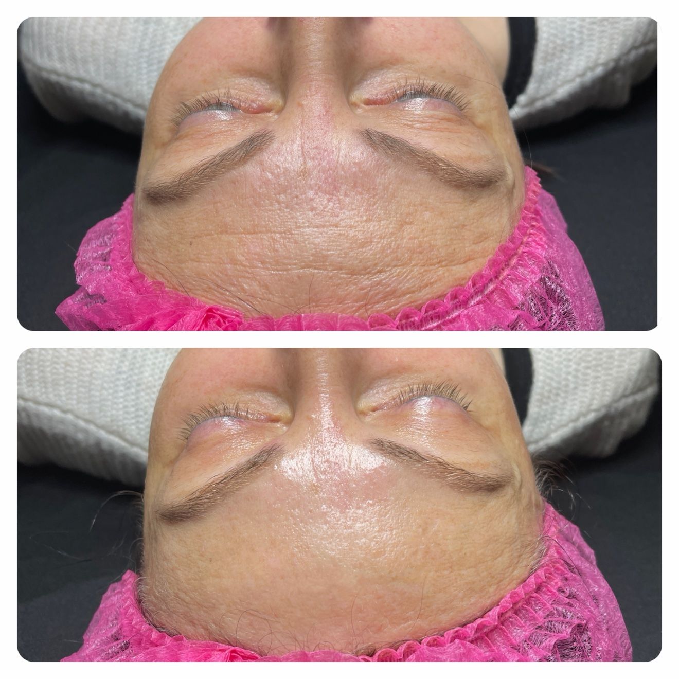 Forehead lines smoothing before and after treatment by Maryna Savchenko