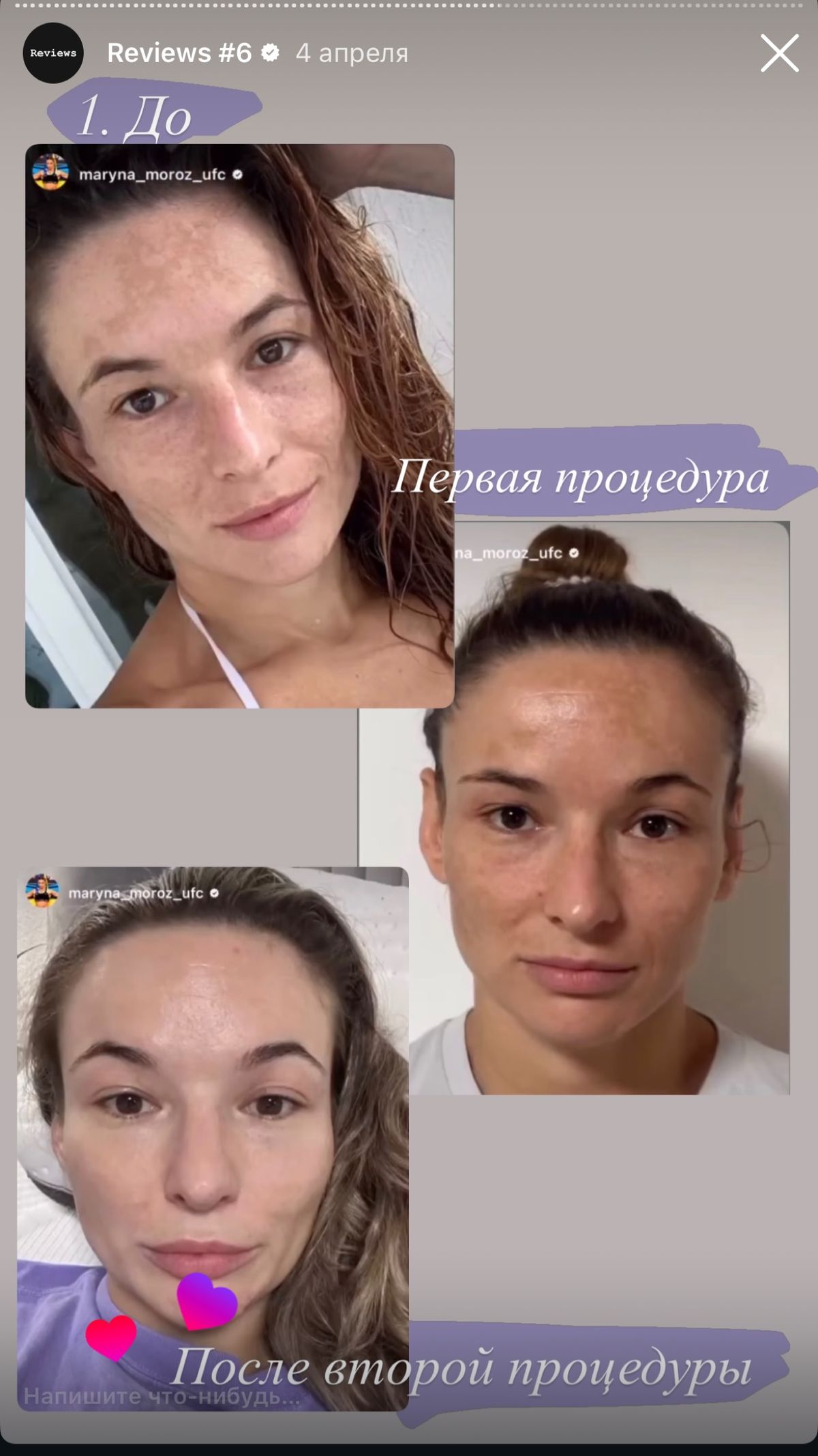 Magic Peel result before and after two sessions with Maryna Savchenko